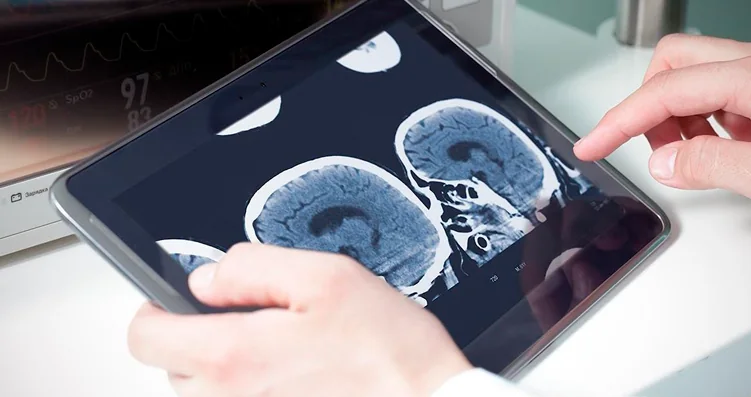 Neurointervencionismo